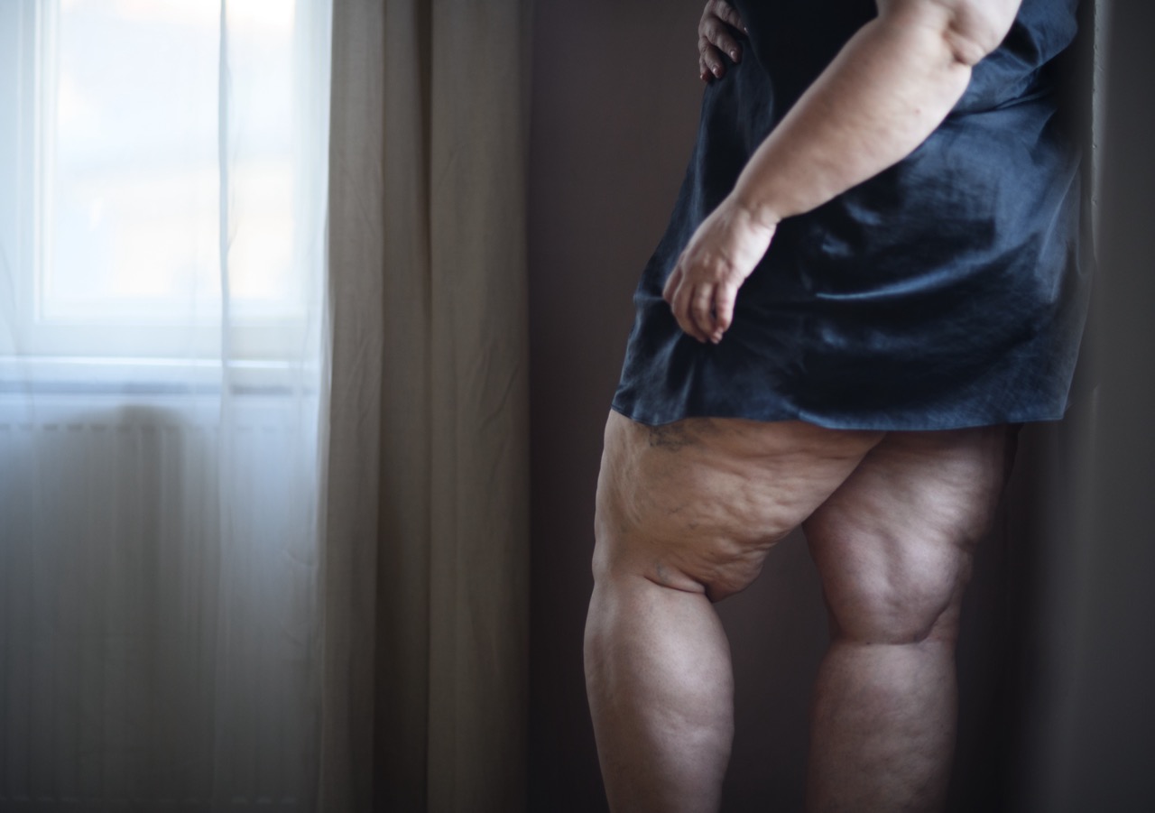 https://lipedema.org.br/wp-content/uploads/2023/11/fat-woman-with-cellulite-on-her-legs-cut-out-2022-04-12-20-14-20-utc-1-Grande.jpeg