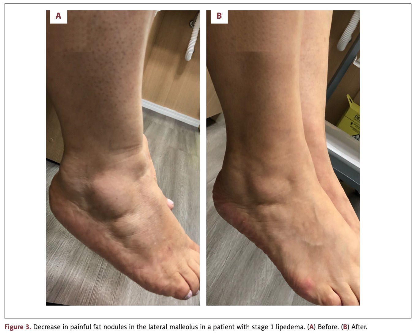 Lipedema antes e depois — tratamento conservador com compressão e fisioterapia