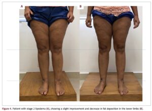 Lipedema antes e depois — lipoaspiração linfosparing em estágio III, visão frontal