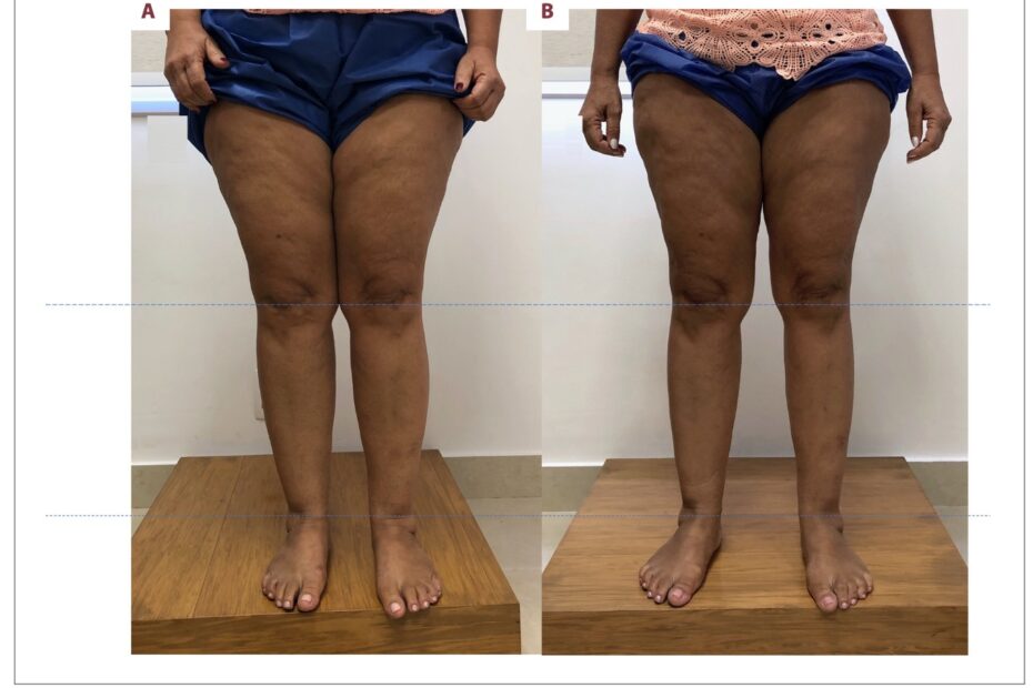 Lipedema antes e depois — lipoaspiração linfosparing em estágio III, visão frontal