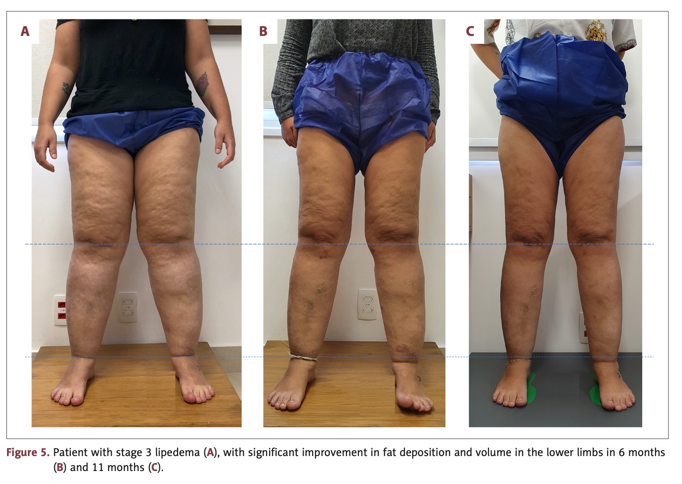 Lipedema antes e depois — lipoaspiração linfosparing em estágio III, visão lateral