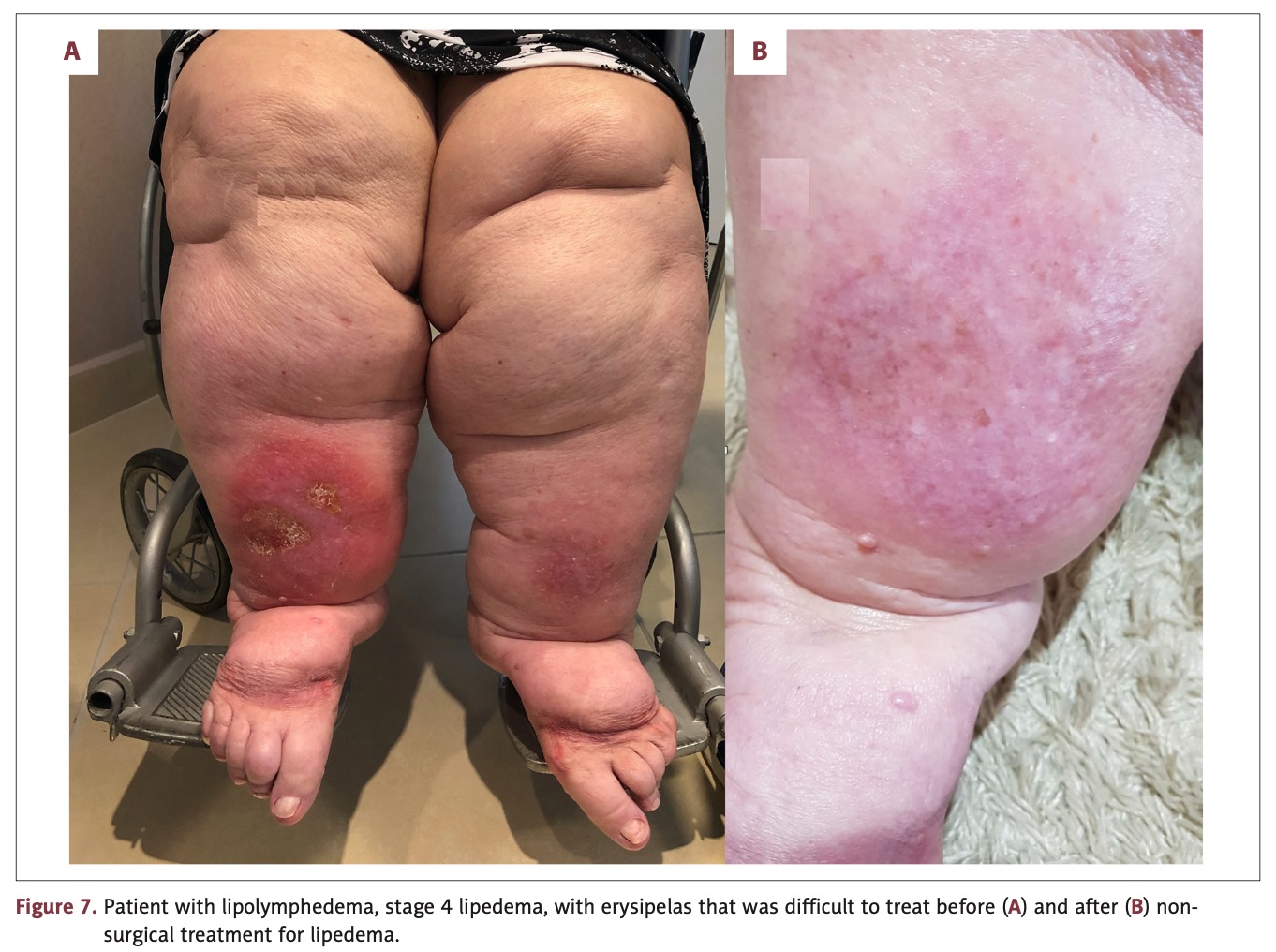 Lipedema antes e depois — lipoaspiração linfosparing, vista posterior