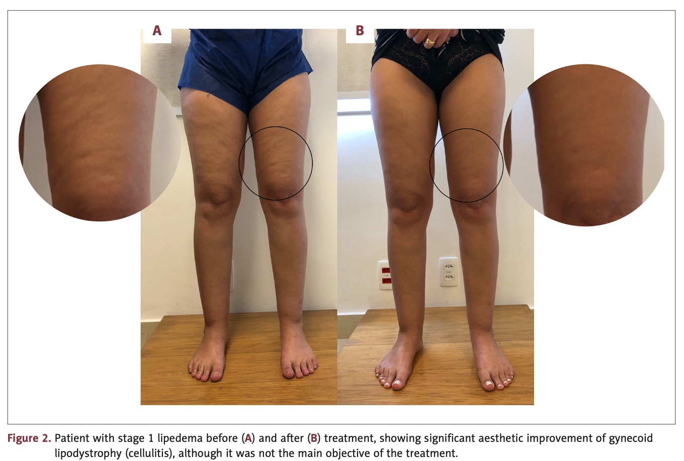 Lipedema antes e depois — lipoaspiração de braços (tipo IV)