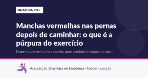 Manchas vermelhas nas pernas depois de caminhar: o que é a púrpura do exercício